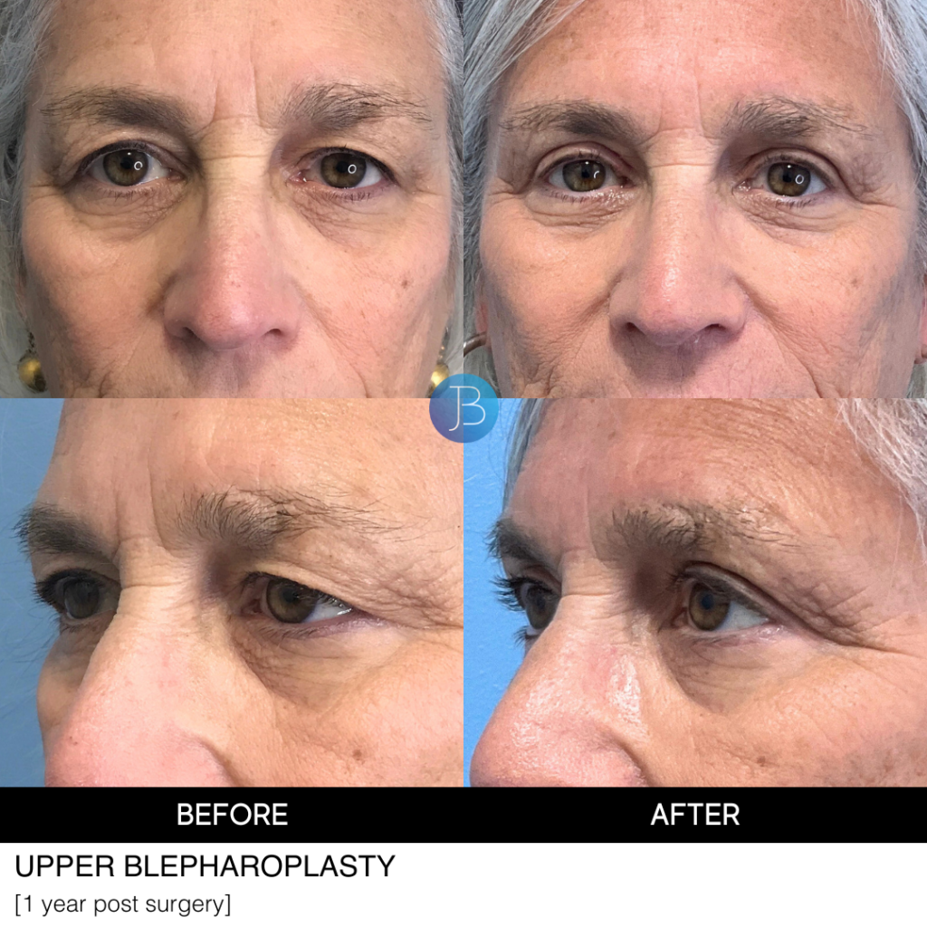 Blepharoplasty by Dr. Jacob Bloom in Chicago