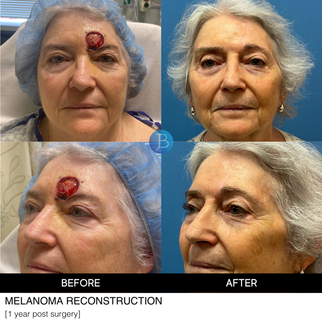 Mohs Reconstruction before and after by Dr. Jacob Bloom