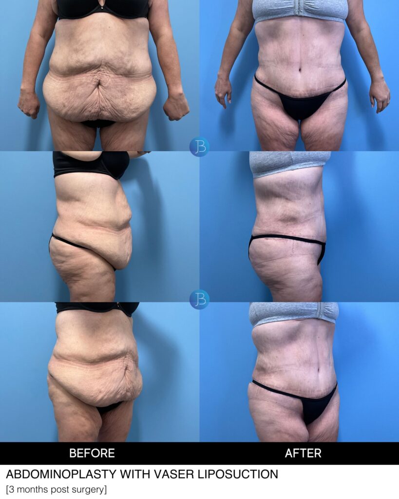 Abdominoplasty completed by Dr. Jacob Bloom in Chicago