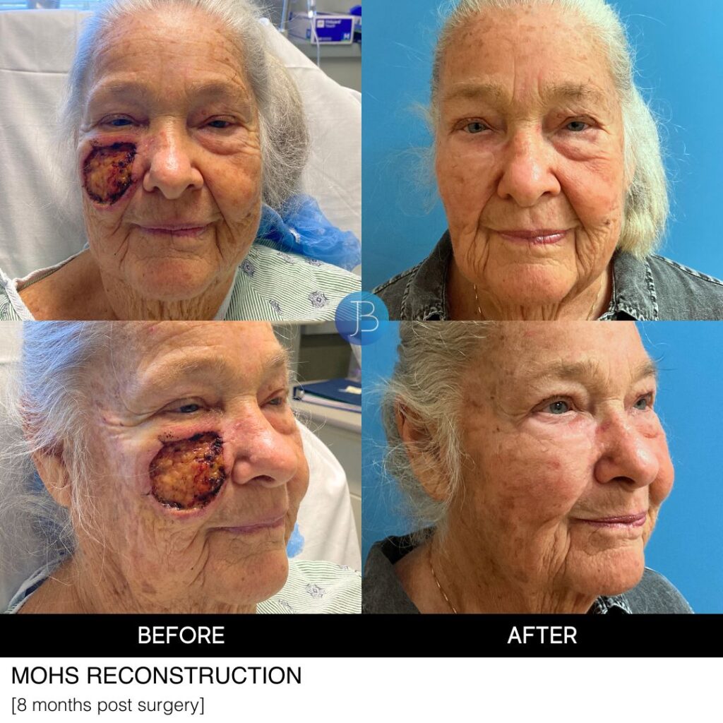 Cheek Reconstruction Mohs by Dr. Bloom in Chicago