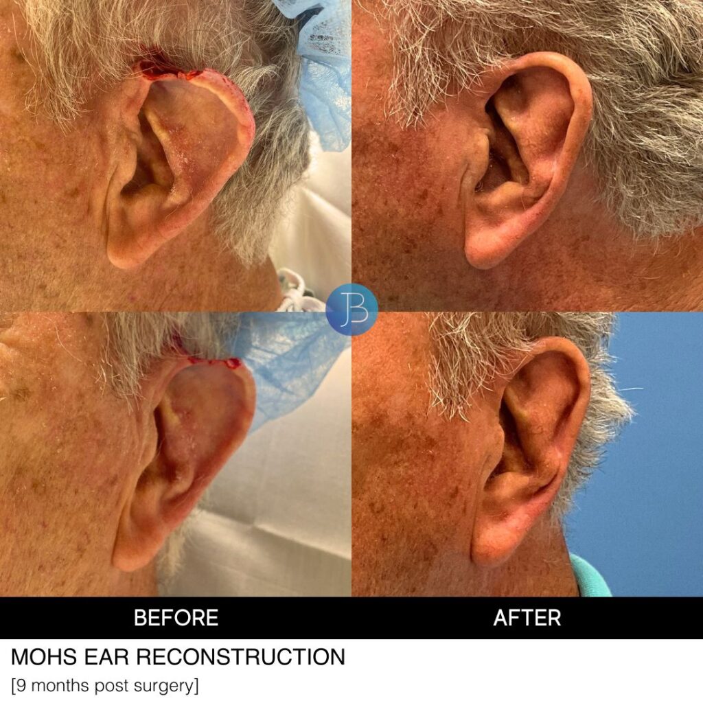 Ear Reconstruction by Dr. Jacob Bloom in Chicago