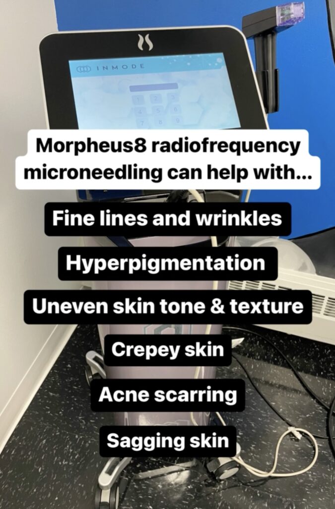 Reasons to use Morpheus8 radiofrequency microneedling