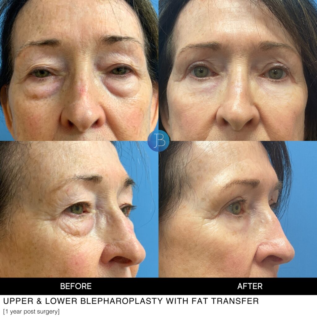 Blepharoplasty before and after by Dr. Jacob Bloom