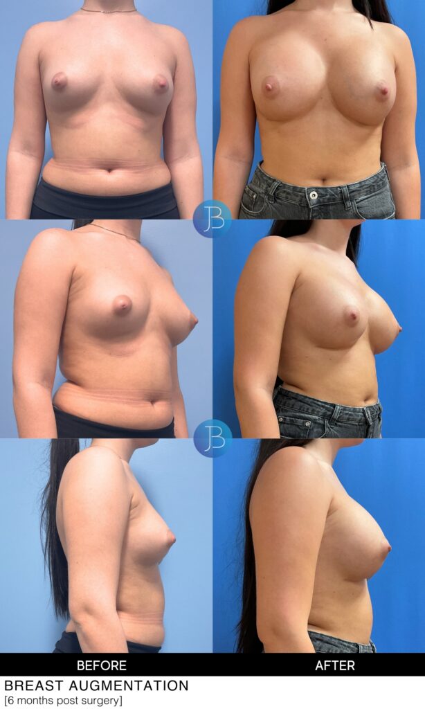 Before and After of a breast augmentation by Dr. Jacob Bloom