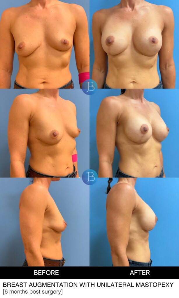 Before and after comparison photos of a breast augmentation by Dr. Bloom in Chicago