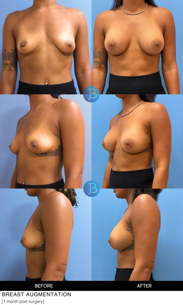 Breast augmentation before and after photos. Surgery by Dr. Jacob Bloom in Chicago