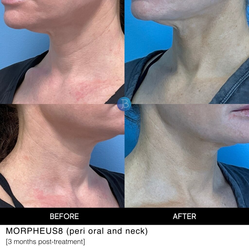 Morpheus8 treatment of the neck before and after photos