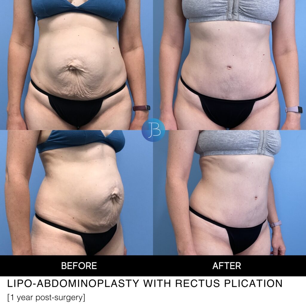 Liposuction abdominoplasty with rectus plication performed by Dr. Bloom in Chicago