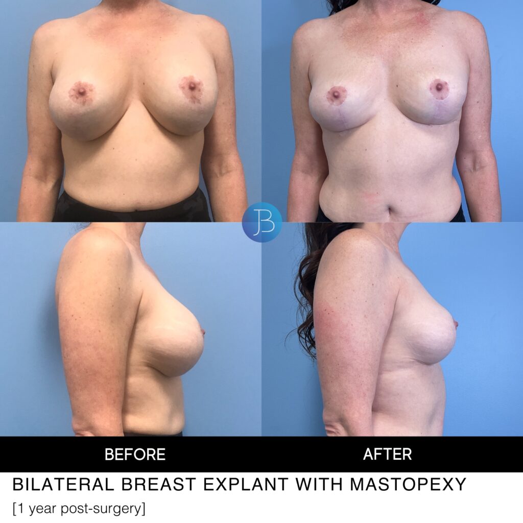 One year post bilateral breast implant removal (explant) with mastopexy performed by Dr. Bloom