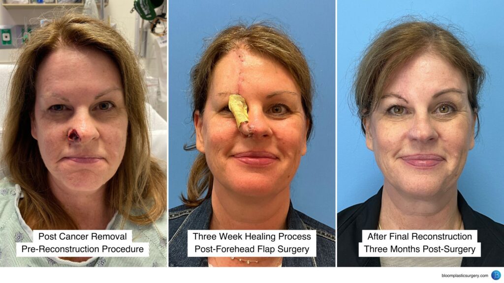 Process images of nasal reconstruction after skin cancer; nasal reconstruction after Mohs surgery Hinsdale.