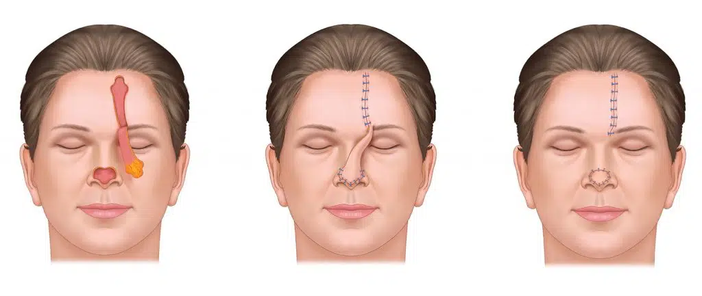 Illustration of a Paramedian Forehead Flap procedure