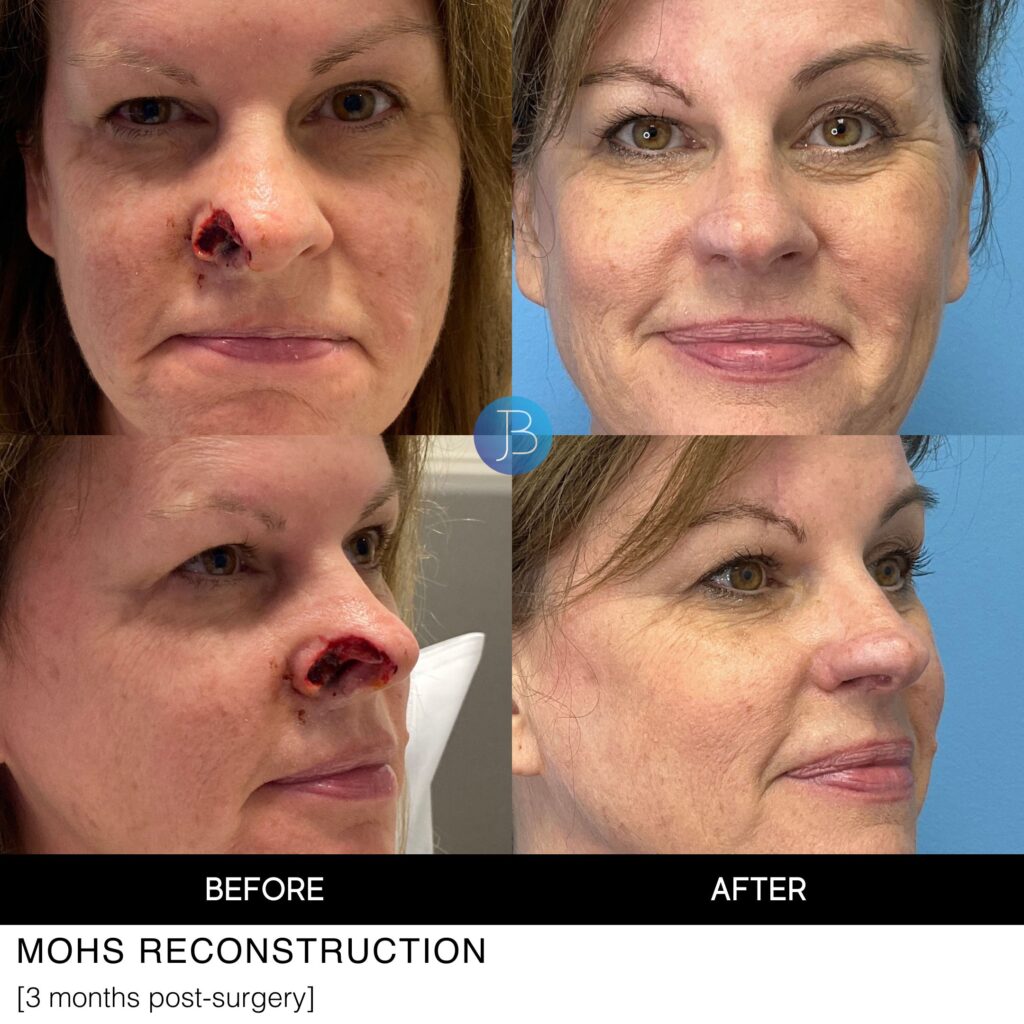 Nose reconstruction after cancer removal