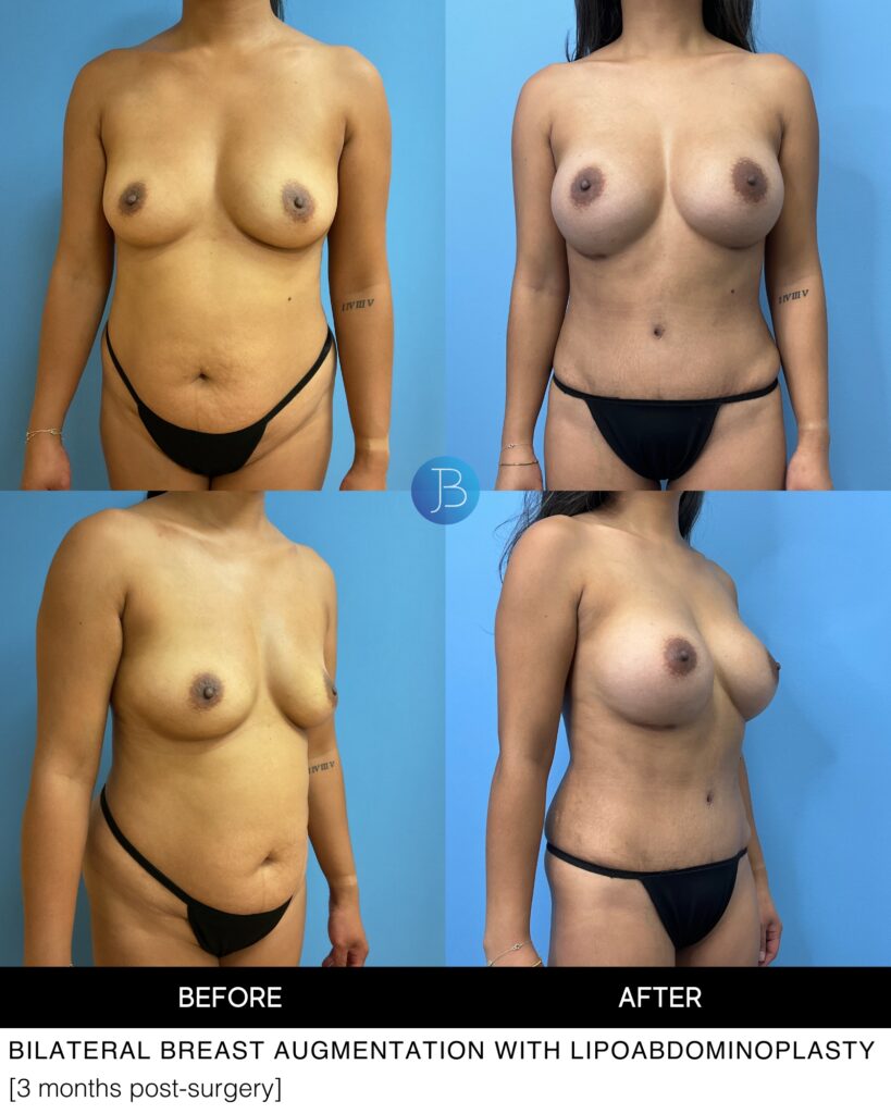 3 months post bilateral breast augmentation with a lipoabdominoplasty