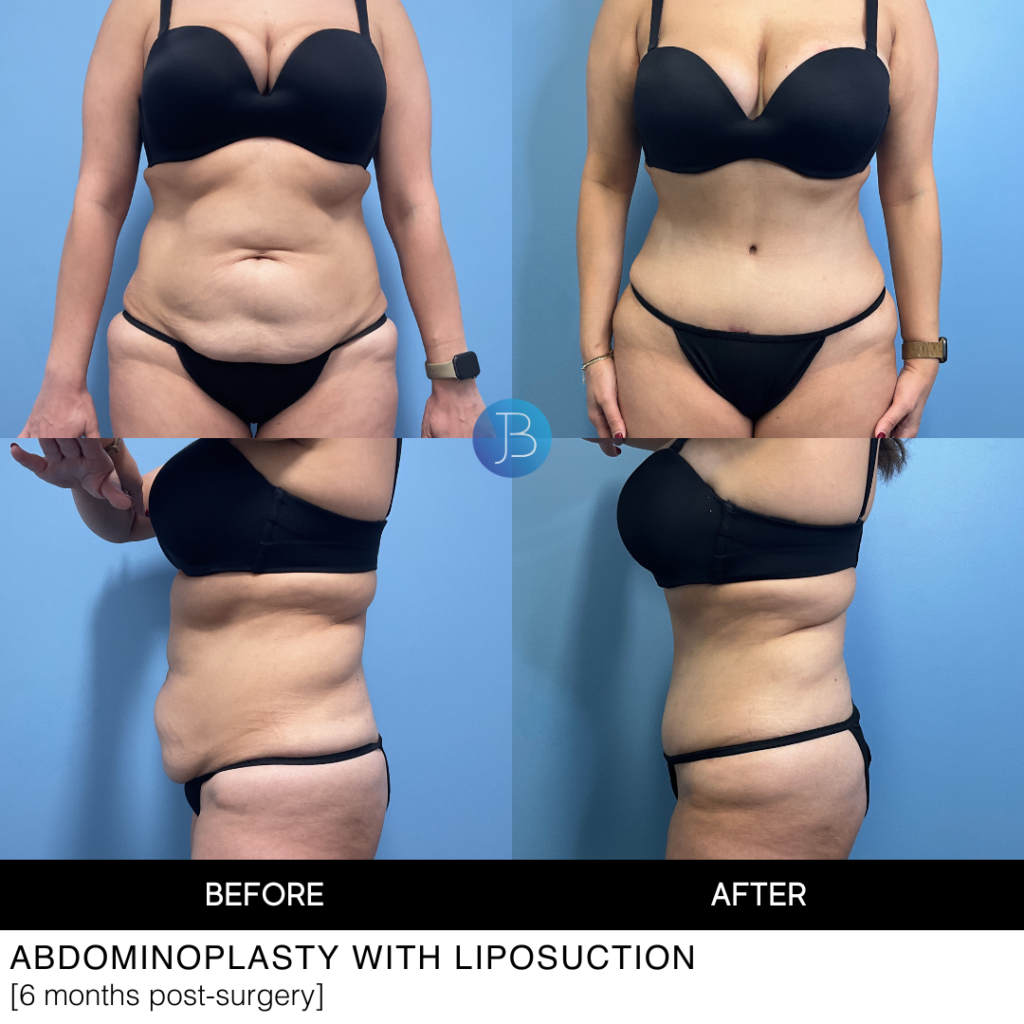 Abdominoplasty with liposuction before and after photos