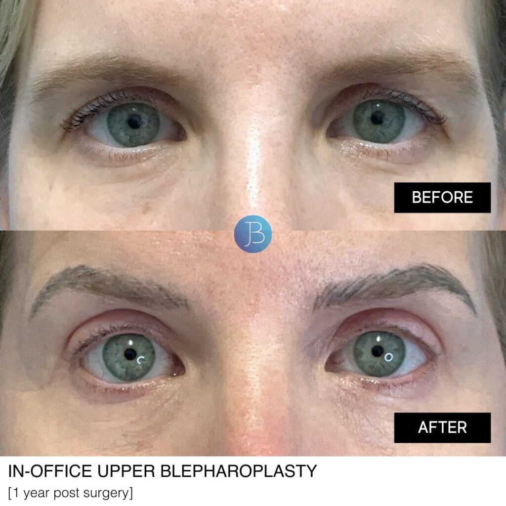 In-office upper blepharoplasty done by Dr Jacob Bloom in Chicgo