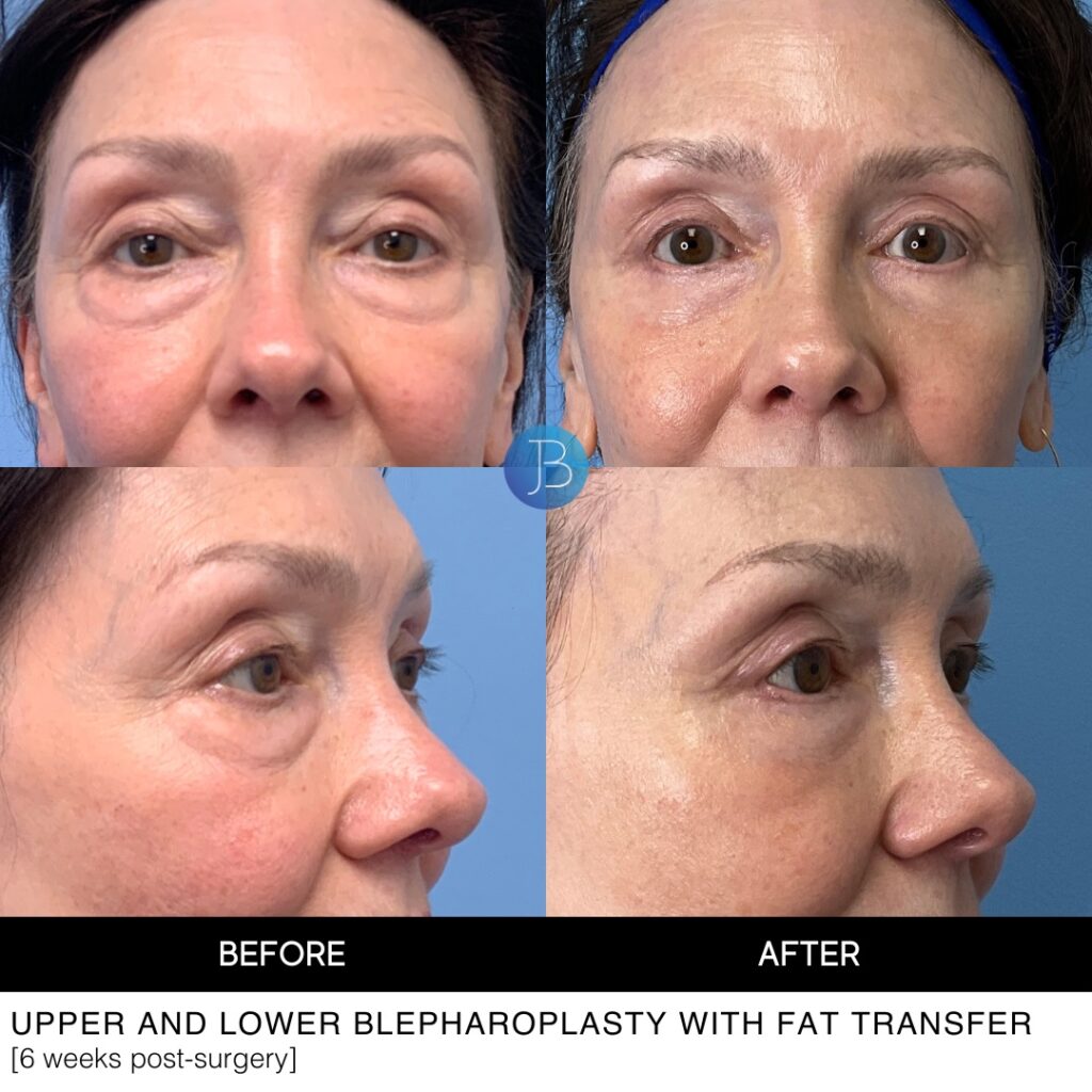 Upper and lower blepharoplasty by Dr Jacob Bloom in Chicago