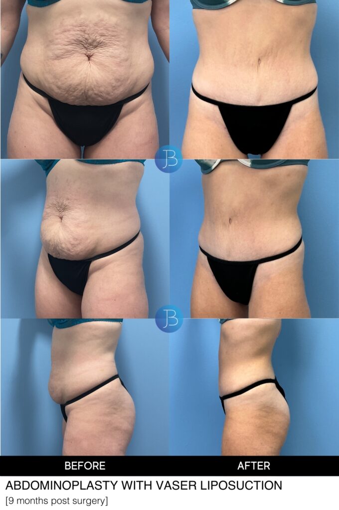 Abdominoplasty with liposuction by Dr Bloom in Chicago and Hinsdale