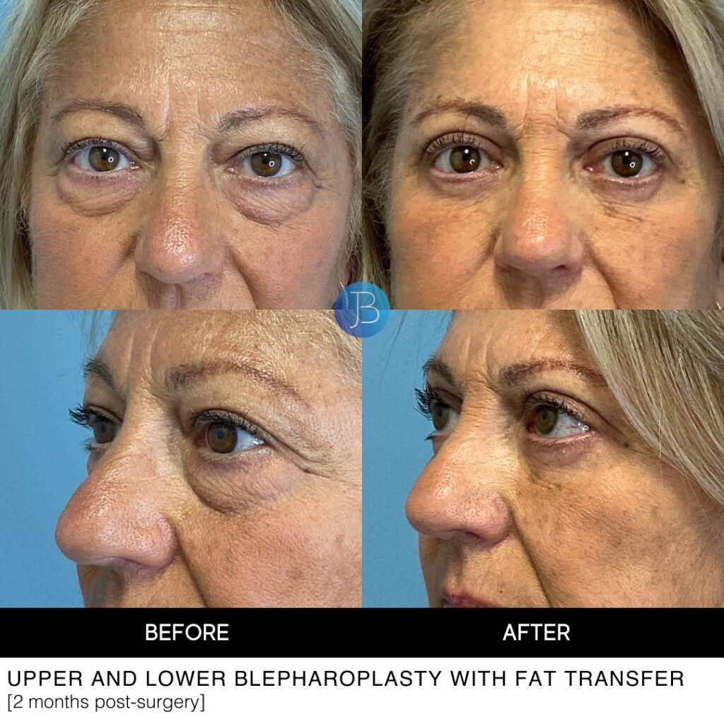 Upper and Lower Blepharoplasty Eyelid lift by Dr Jacob Bloom in Chicago and Hinsdale