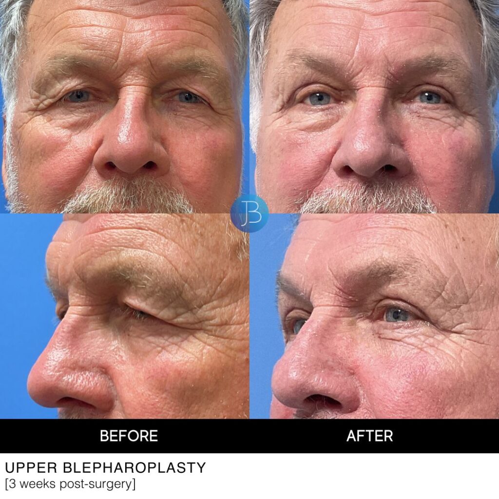 Upper blepharoplasty on a man, before and after images