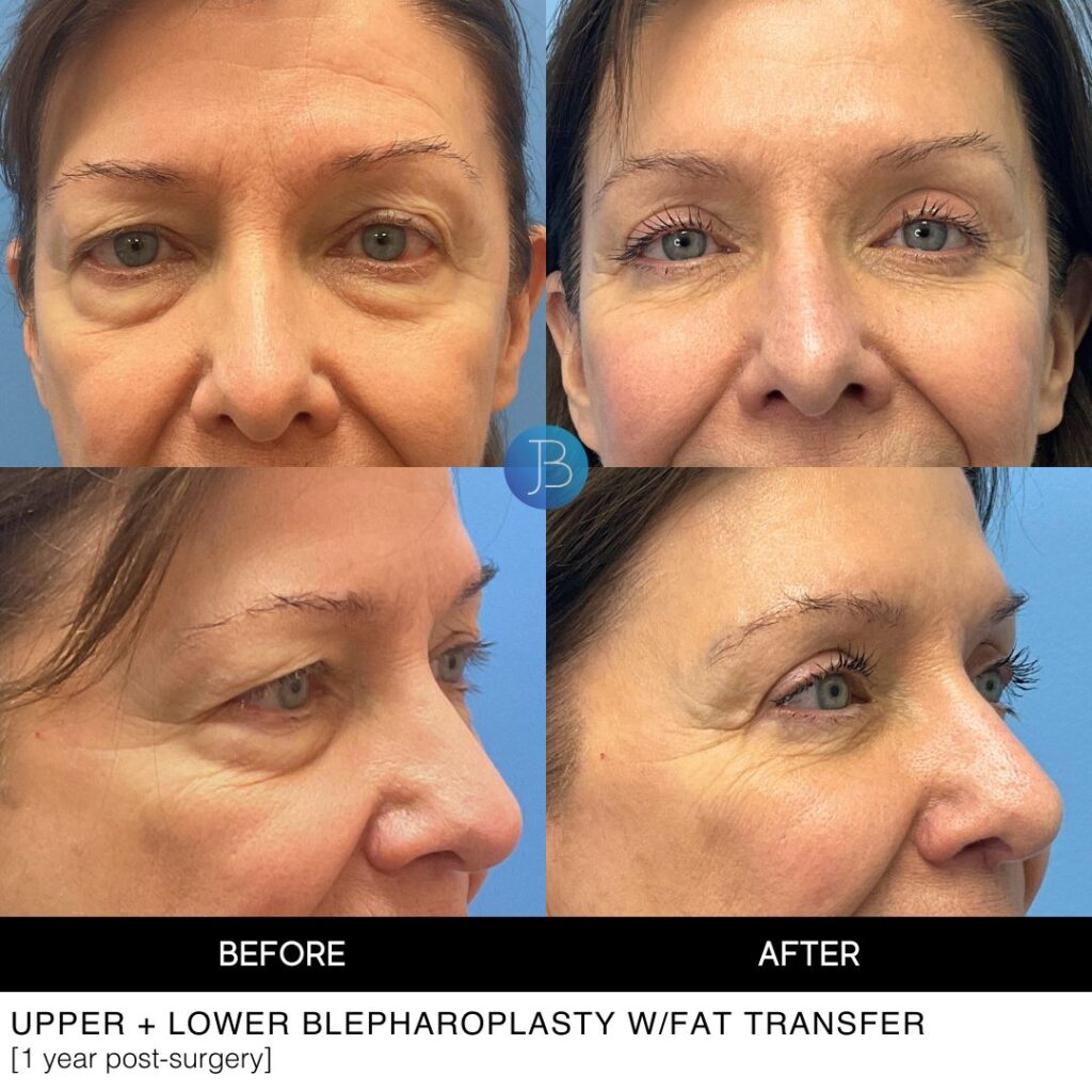 Quad Blepharoplasty with fat transfer before and after results