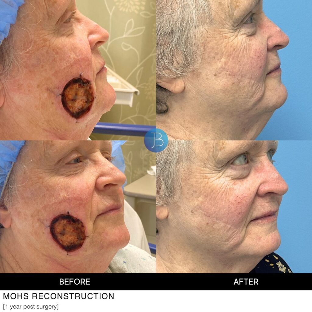 Cheek reconstruction after MOHS surgery