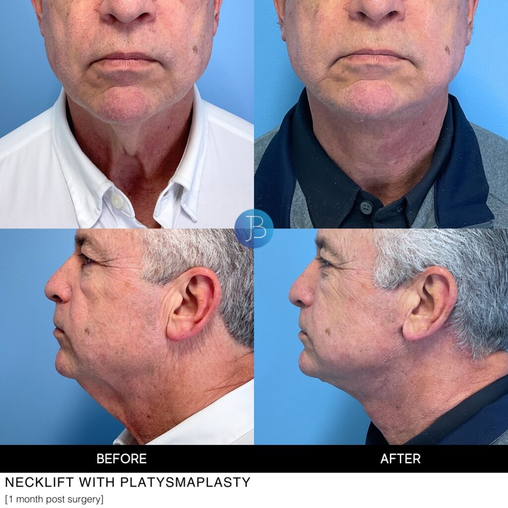 Necklift by Dr Jacob Bloom