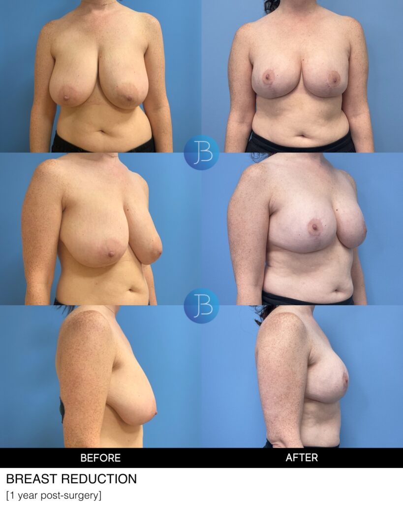 Breast Reduction by Dr. Bloom