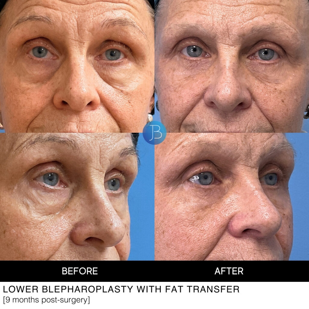 Lower blepharoplasty with fat transfer before and after